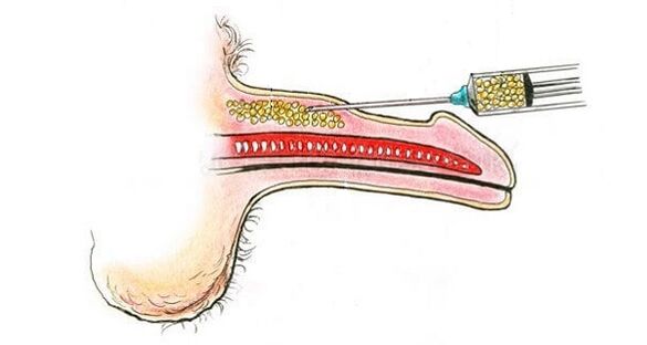 Hialuronskābes injekcijas locekļa mucā, lai to palielinātu